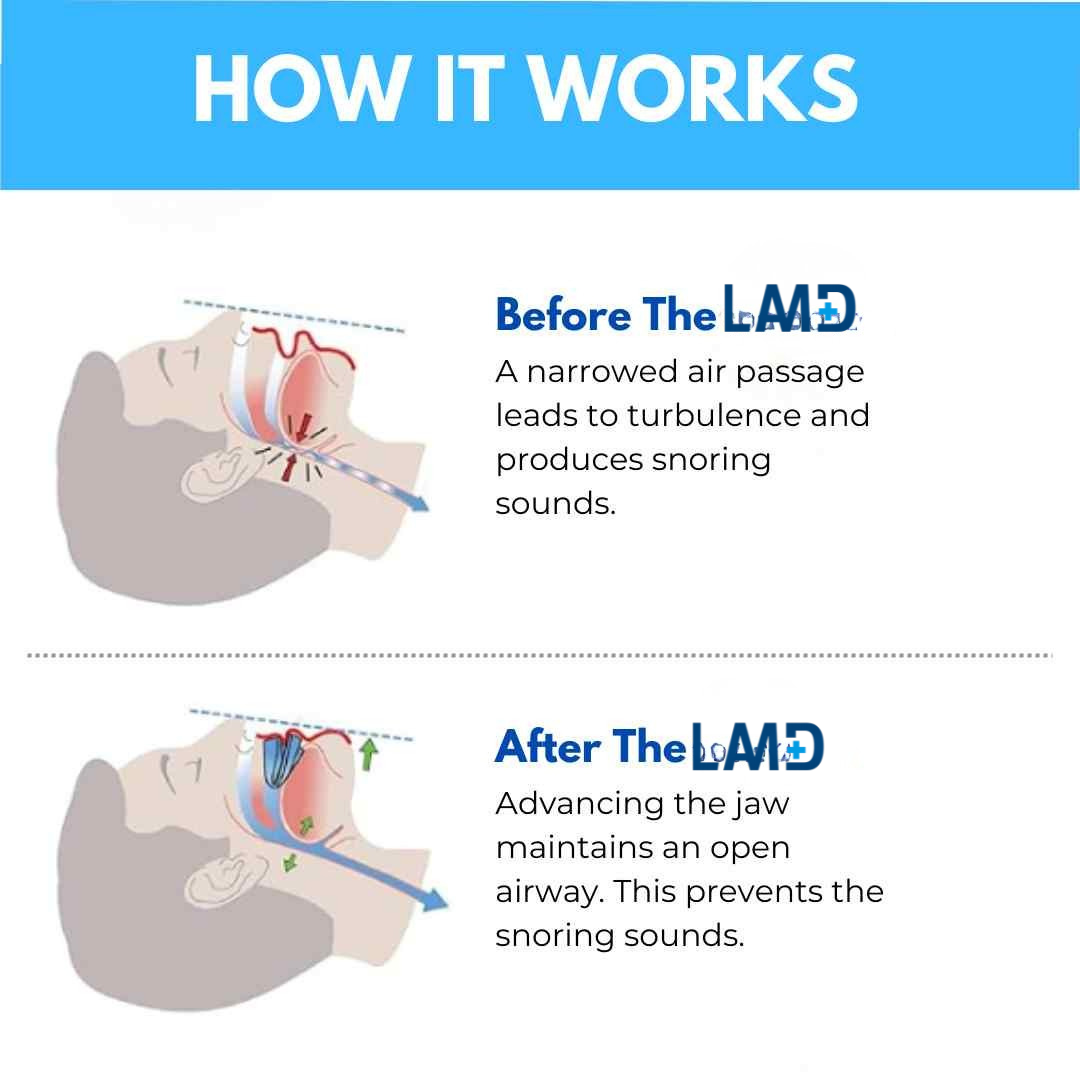 LAMD's ANTI SNORING MOUTHPIECE